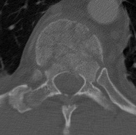 Burst Fracture CT No Canal Compromise